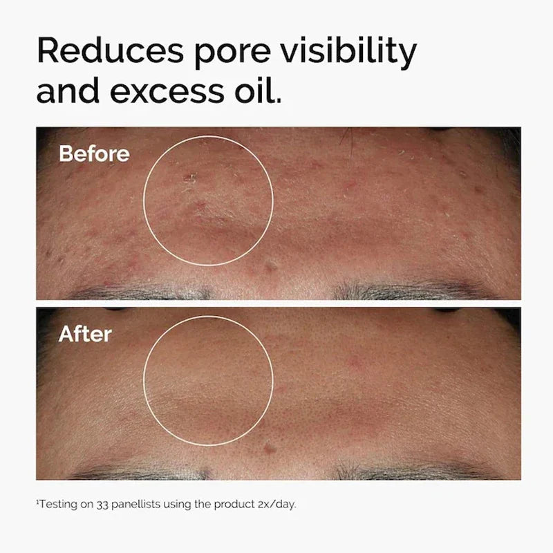 Korean Niacinamide 10% + Zinc 1% Serum 30ml Multi Effect Improve Texture Reduce Excess Oil Strengthen Skin Moisture Barrier